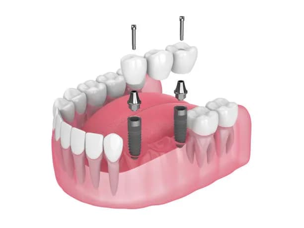 Dental crowns & bridges at SmileKraft Dental Jersey City