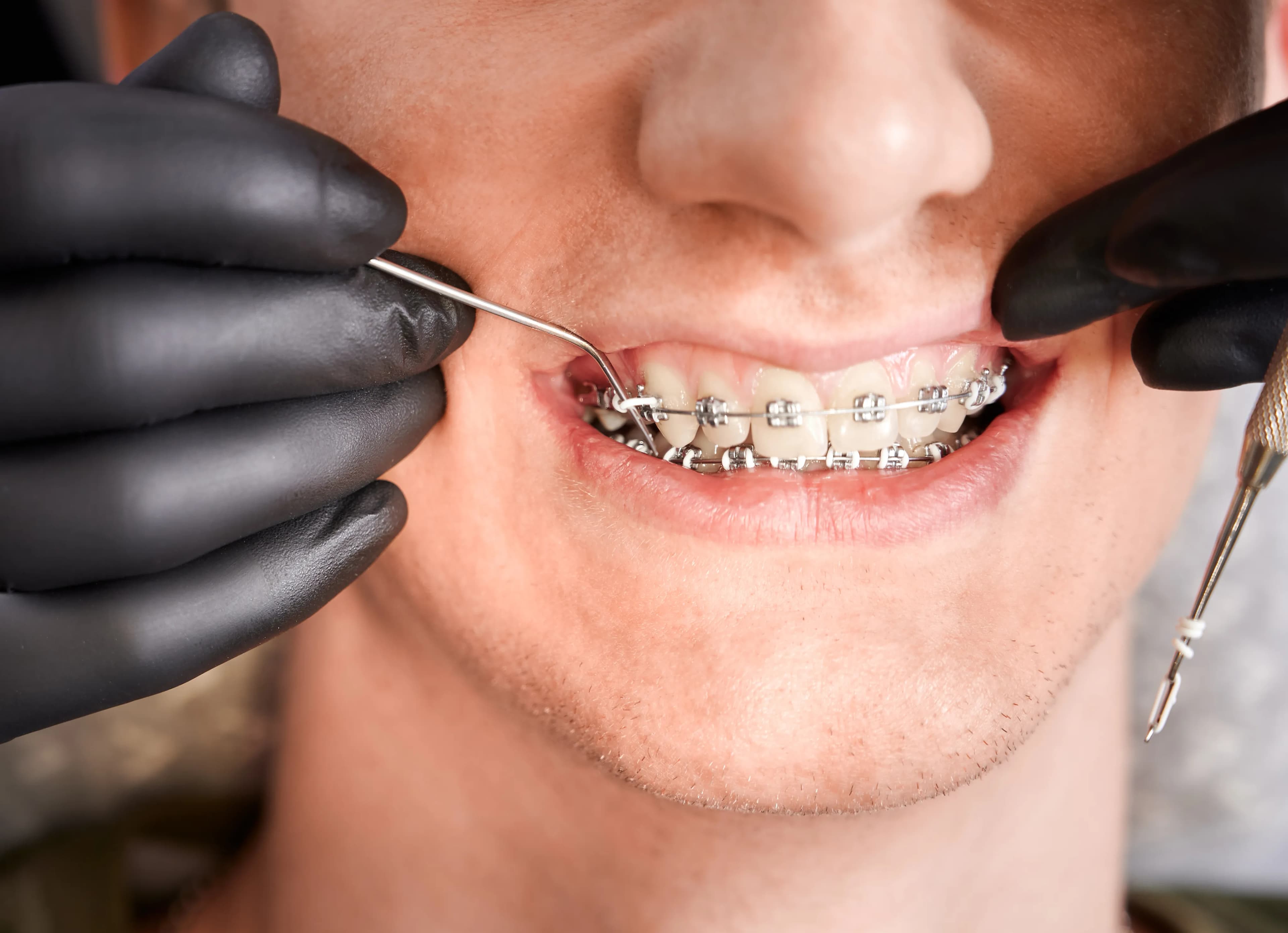 Orthodontics treatment at SmileKraft Dental Jersey City